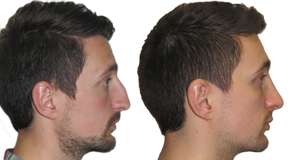 Nose Reshaping