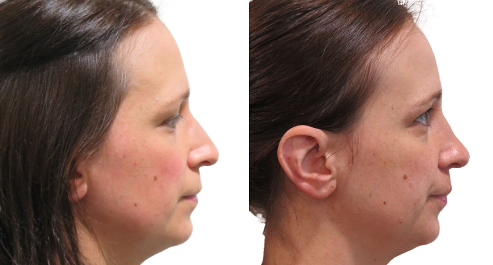 Nose Reshaping