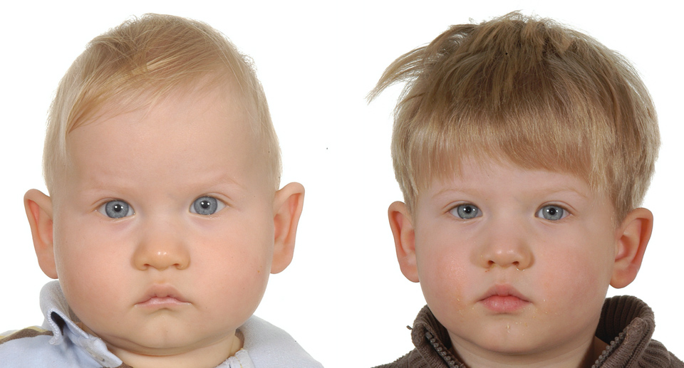 Craniosynotosis Surgery