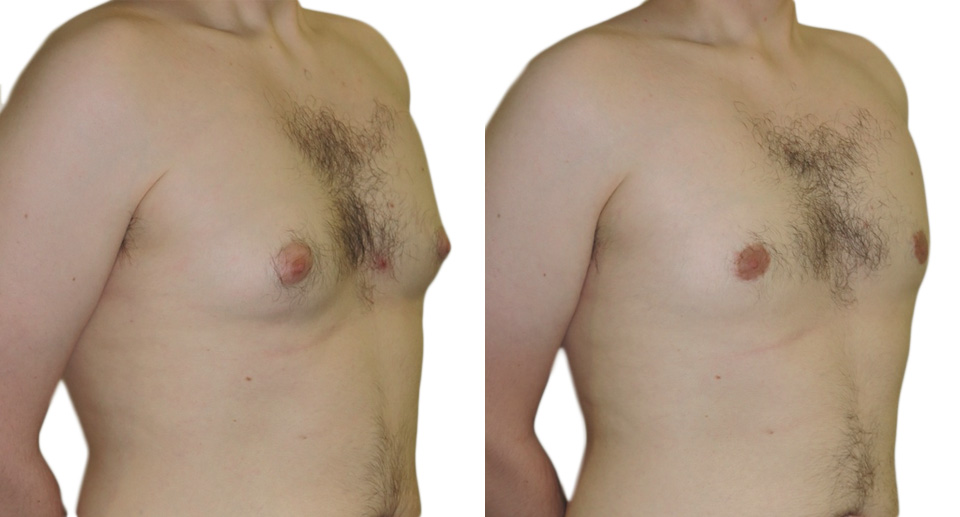 Plastic surgeon to the stars dubs 2021 'year of the male breast reduction'  saying demand has doubled since lockdown - MyLondon